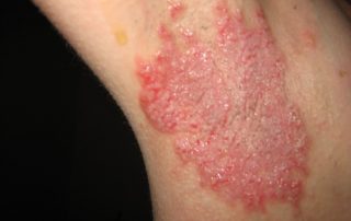 Sherwood Forest Toxic Chemical Exposure Attorney thumbnail